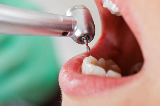 Best Emergency Treatment for Dental Infections or Abscesses in Big Le, AK